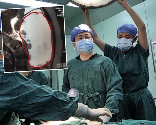 15歲少女卵巢有20多厘米惡性腫瘤。網圖