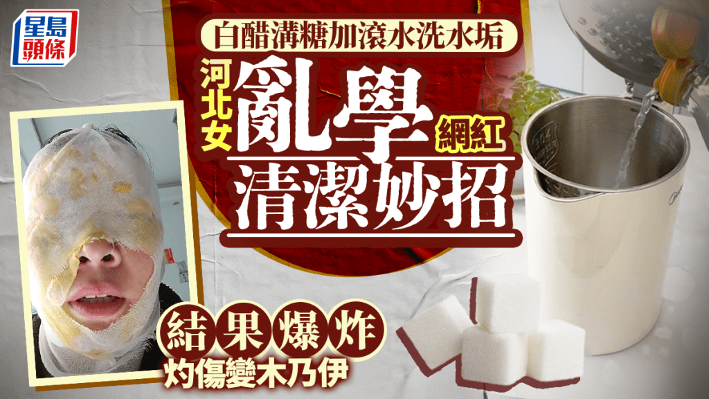 吳女士亂學網紅妙招除水垢,導致面部嚴重燙傷。