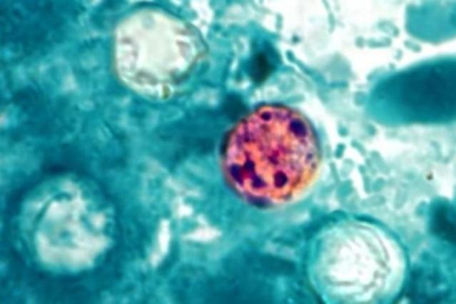 全美31州爆發環孢子蟲疫情。CDC官網