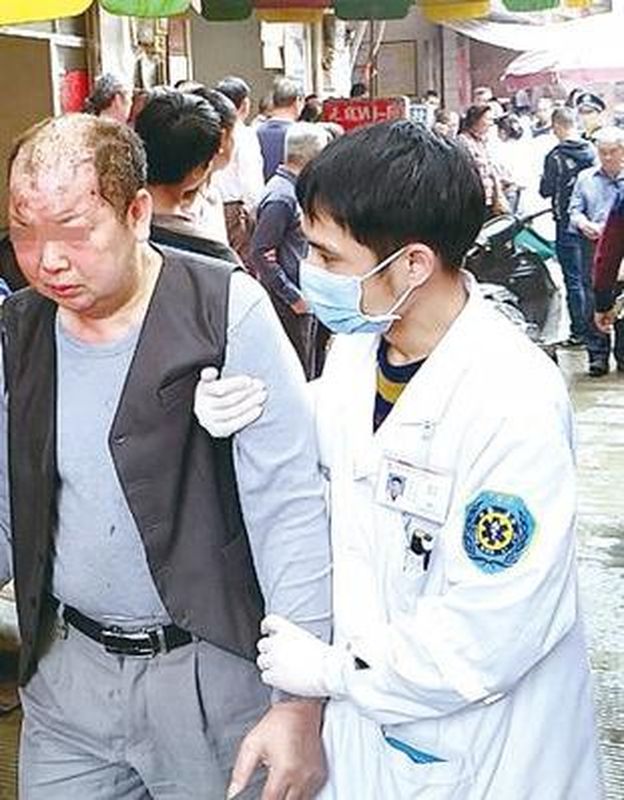 有人头发被烧焦,所幸伤势并不严重。