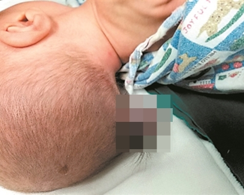 男嬰後腦長出「小尾巴」。 網上圖片