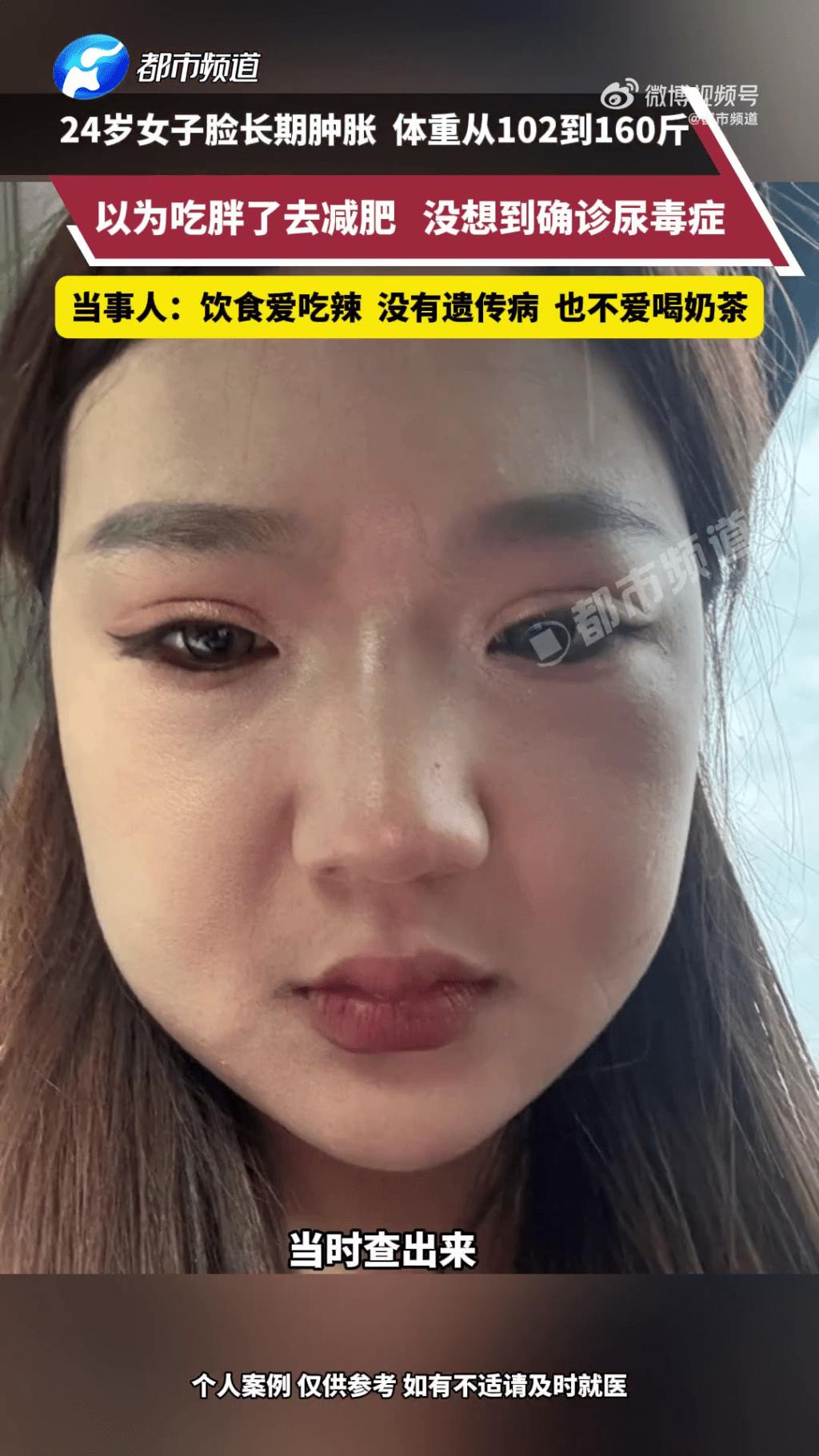 暴增近30kg以為吃多了，女子半年減肥25kg後確診尿毒症。 都市頻道