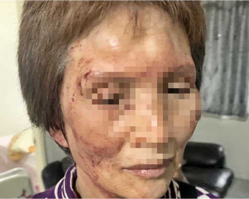 台灣一名老婦遭女租客打傷，需要縫針處理。FB「我是新莊人」圖片