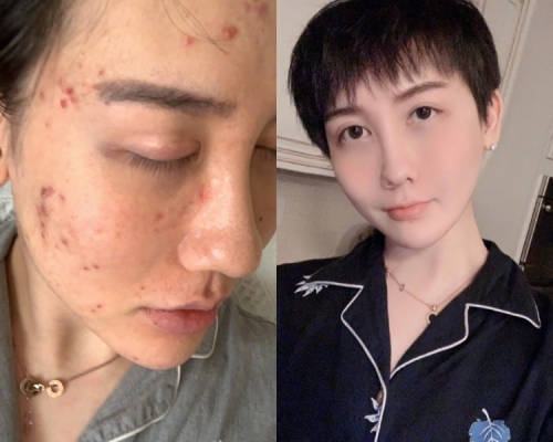 劉梓晨指自己突然消失因為毀容。網圖