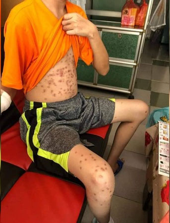 身上的傷痕來自汽槍射擊,以及電擊。(網圖)