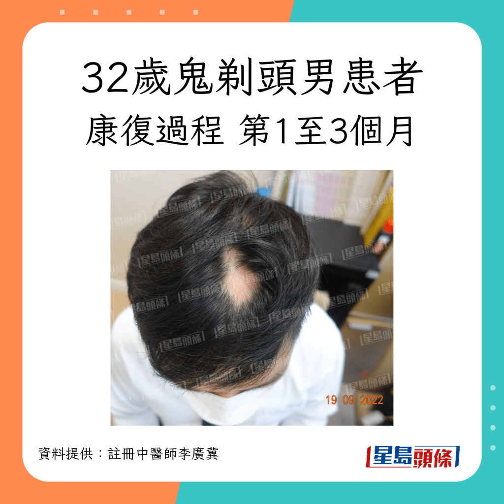 32歲脫髮（鬼剃頭）男患者康復過程，經中醫治療第1至3個月