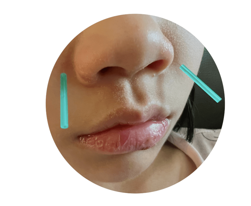 迎香穴位 迎香穴位