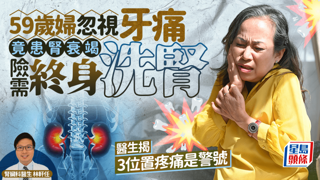 59歲婦忽視牙痛竟患腎衰竭 險需終身洗腎 醫生揭3位置疼痛是警號