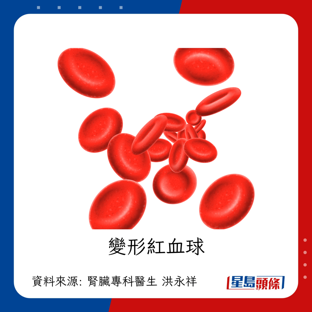腎功能變差的症狀：變形紅血球