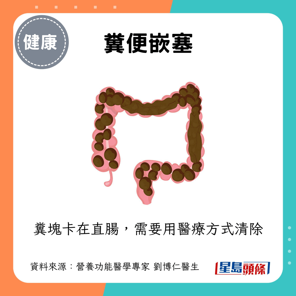 糞便嵌塞 糞便嵌塞