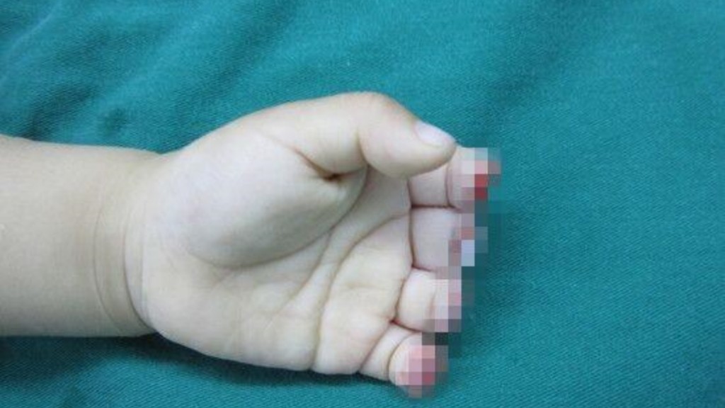 明明左手4個手指全部斷掉了。