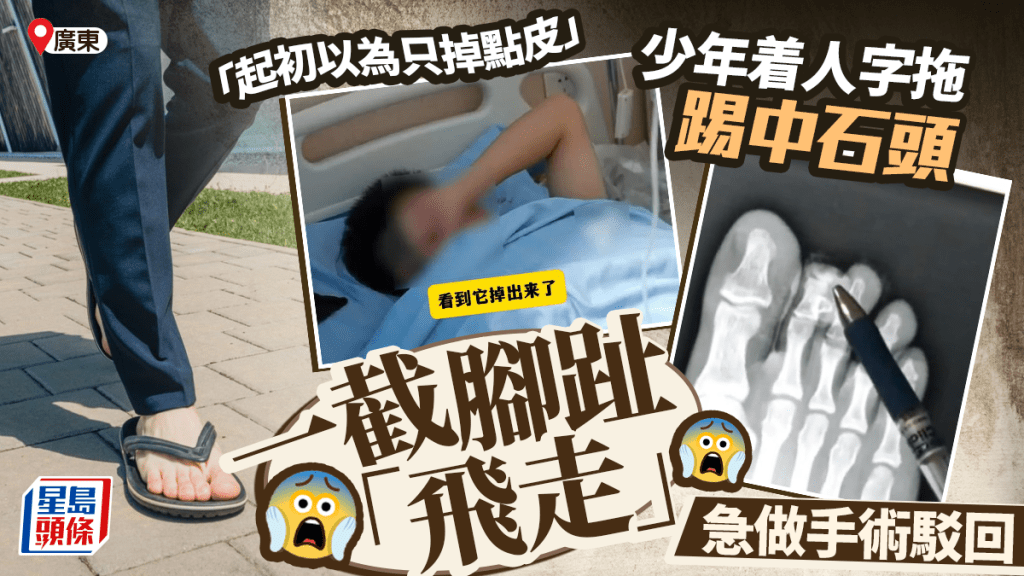 廣東16歲少年著人字拖行路玩手機，踢中石頭致一截腳趾飛脫。