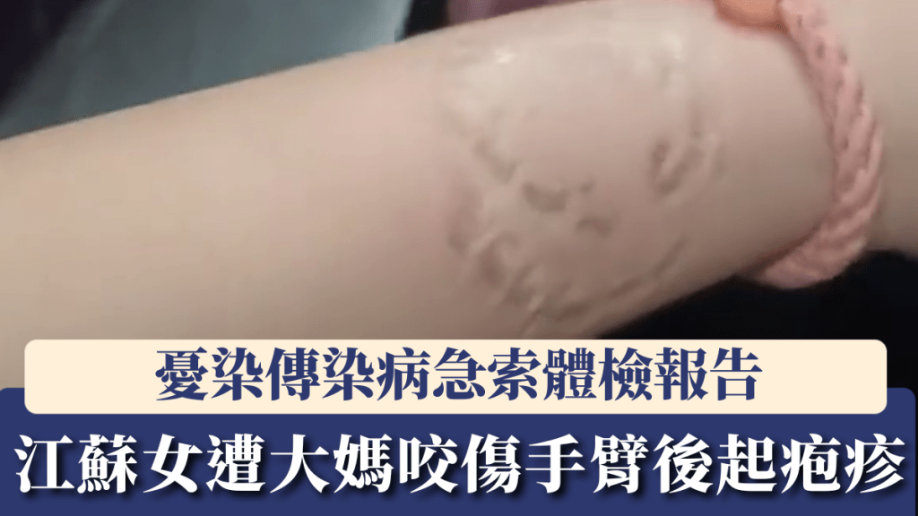 江蘇女遭霸座大媽咬傷手臂後起疱疹，憂染傳染病急索體檢報告。