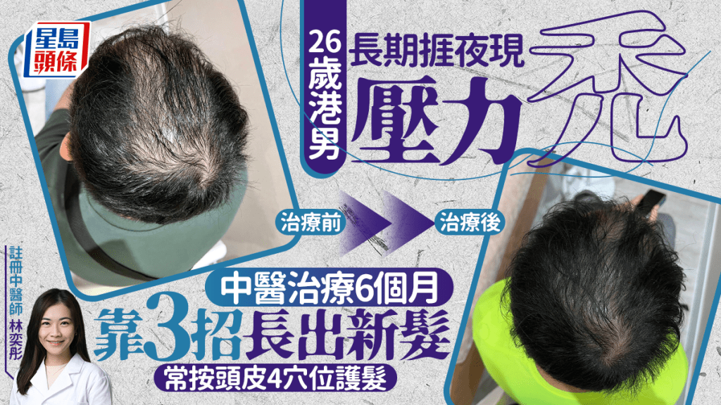 男士脫髮｜26歲港男長期捱夜現壓力禿 中醫治療6個月長出新髮 常按頭皮4穴位護髮