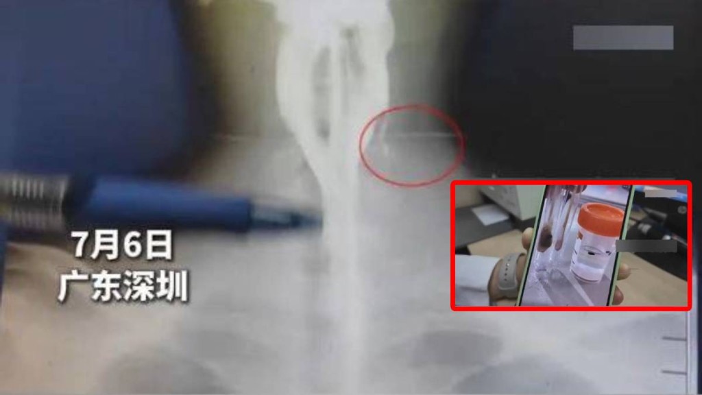 阿偉20年前吃瓜子卻有7粒「走去」頸部，近日他膿腫脹痛才發現。新晚報
