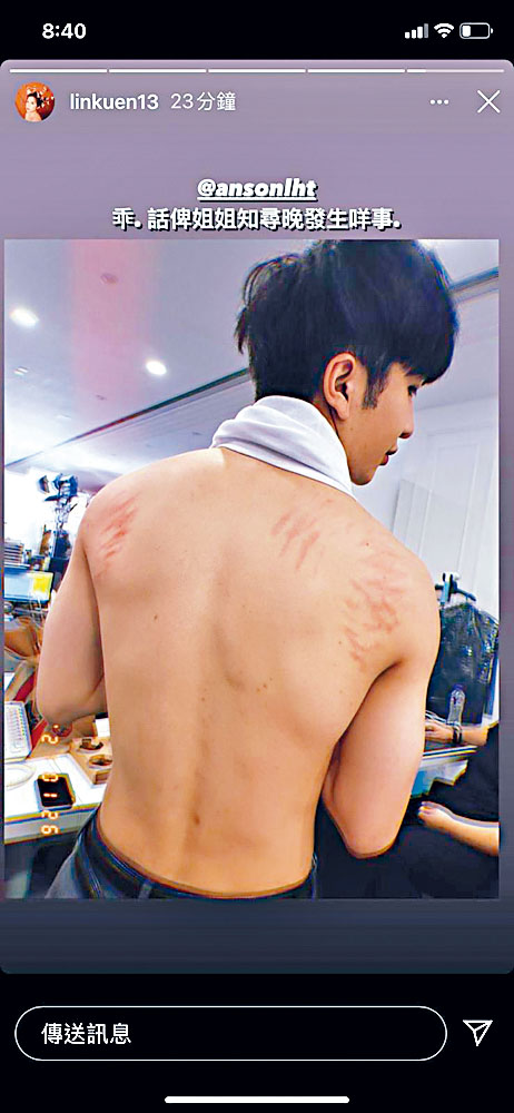 Anson Lo背部布满「伤痕」，原来系冷衫敏感。