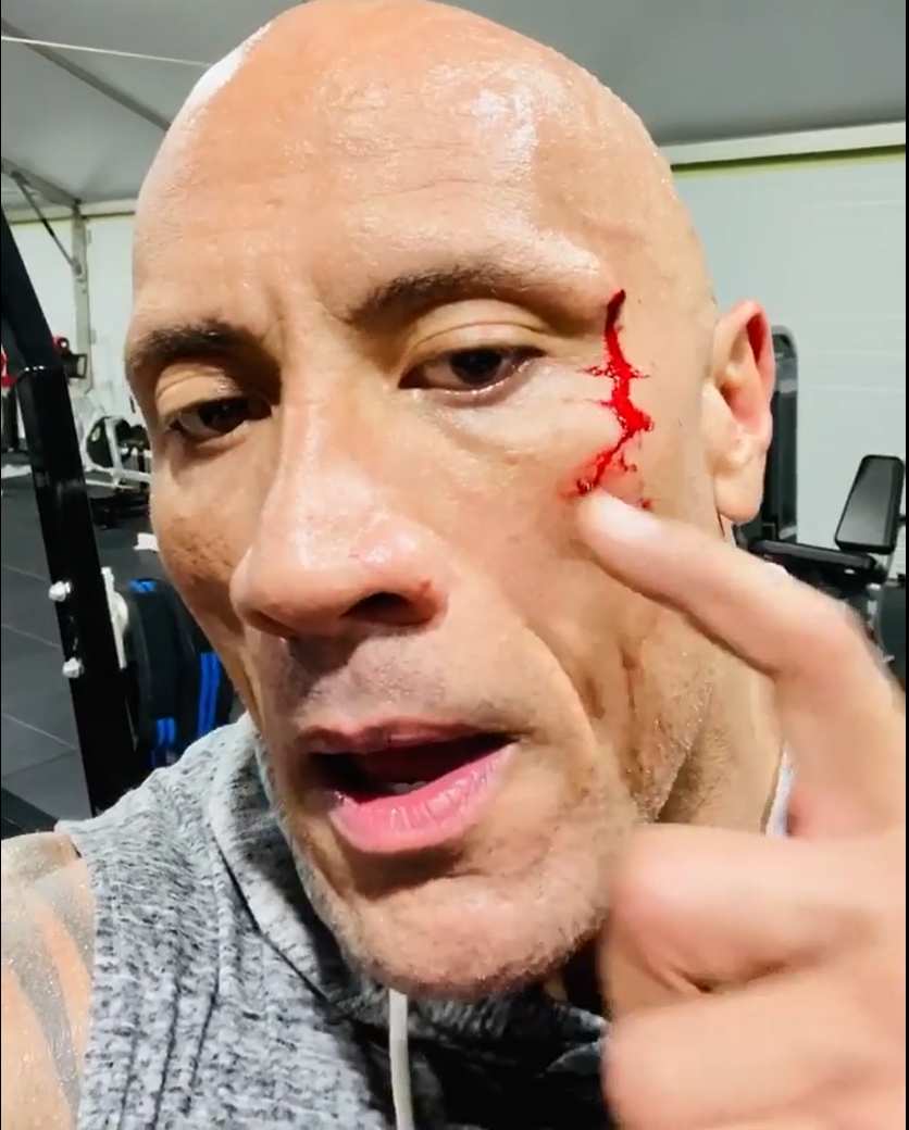 狄維莊遜表示自己健身時不慎發生意外，被50磅的鐵鏈割傷。