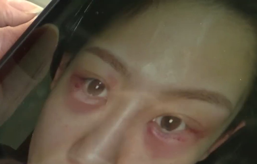 小呂手術失雙眼出現過敏，眼肚位置甚至出現流膿。1818黃金眼