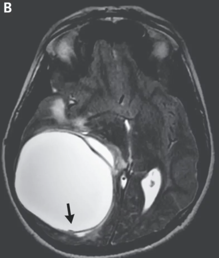 少年腦部巨型囊腫。圖片來源：THE NEW ENGLAND JOURNAL OF MEDICINE ©2023