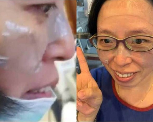 花蓮慈濟醫院粉專,貼出了多張醫護口罩戴到臉破皮照片,甚至有醫護需貼上人工皮。(網圖)
