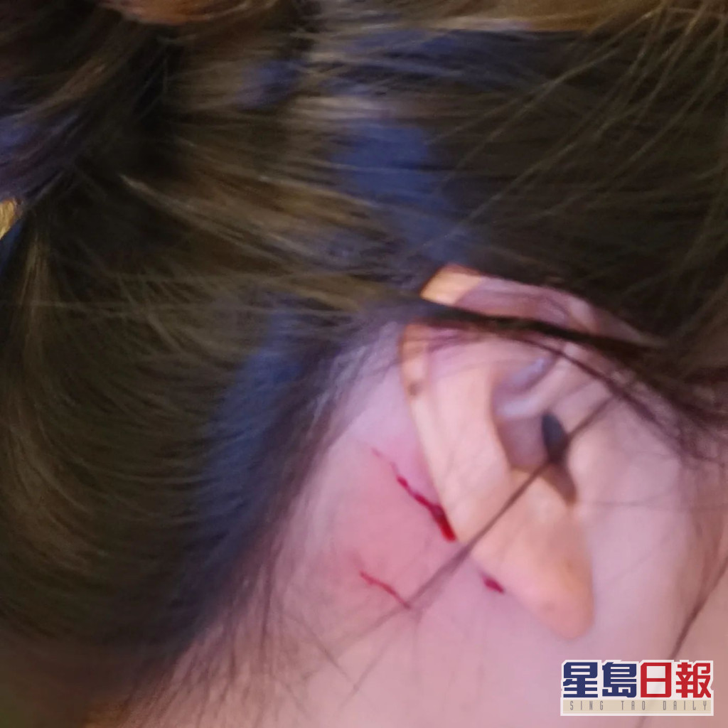 早前黎淑贤被猫爪伤。