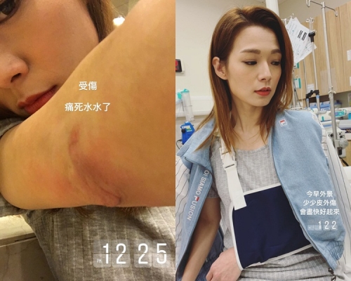 呂慧儀受傷好多粉絲都擔心同心痛。（ig圖片）