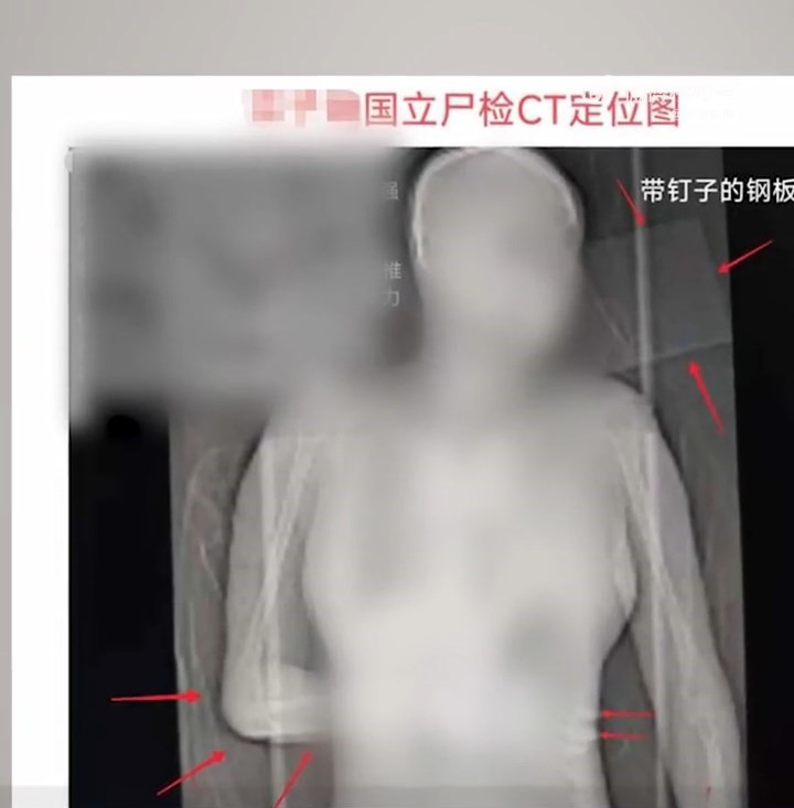尸检CT定位图。澎湃新闻