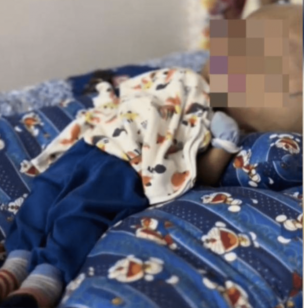 马来西亚3岁男婴莫哈末比拉患上无叶前脑无裂畸形症（Alobar Holoprosencephaly），头部重达28公斤，无法正常坐立。
