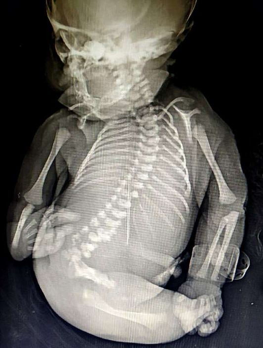 寶寶不但雙腿有缺陷，腎和肺部等器官也有畸形問題。網上圖片