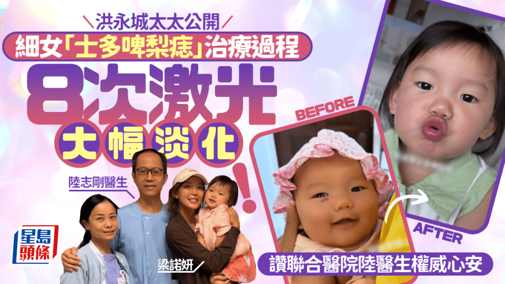 洪永城太太公開細女「士多啤梨痣」治療過程 8次激光大幅淡化 讚聯合醫院陸醫生權威心安