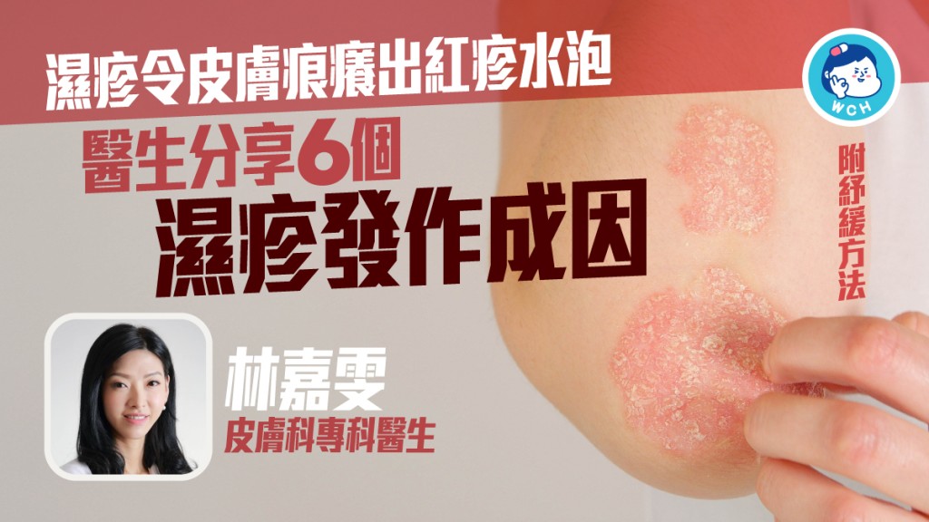 濕疹嚴重可影響日常生活，皮膚科專科醫生林嘉雯教紓緩濕疹方法。