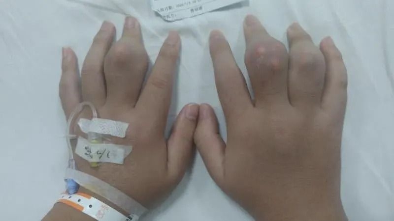 糖尿病酮症酸中毒是糖尿病的一種很嚴重的急性併發症。