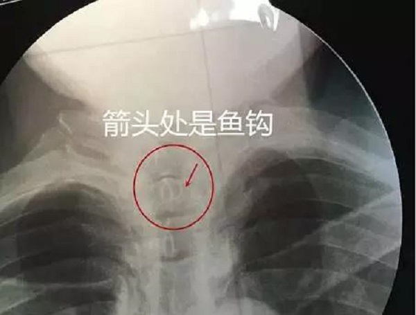 魚鈎卡在食道。網上圖片