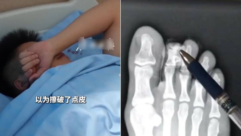 廣東16歲少年著人字拖行路玩手機，踢中石頭致一截腳趾飛脫。廣州日報