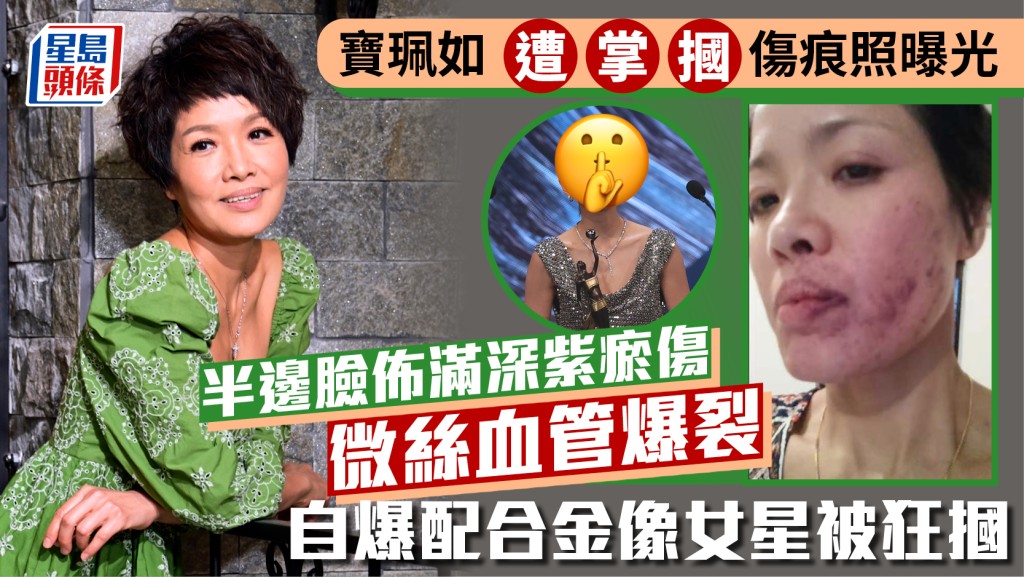 寶珮如被掌摑傷痕照曝光  半邊臉佈滿深紫瘀傷  微絲血管爆裂觸目驚心  打人者係金像女星