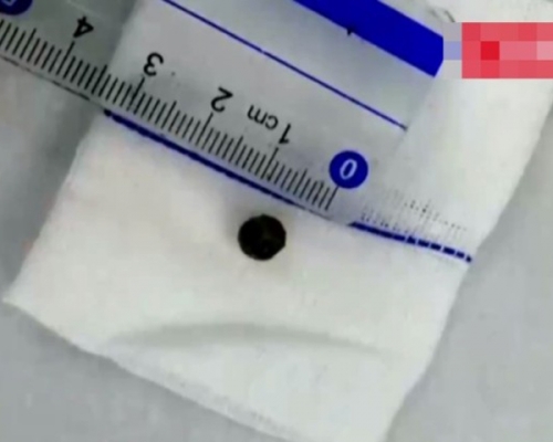 手術後取出的「珍珠」。 網圖