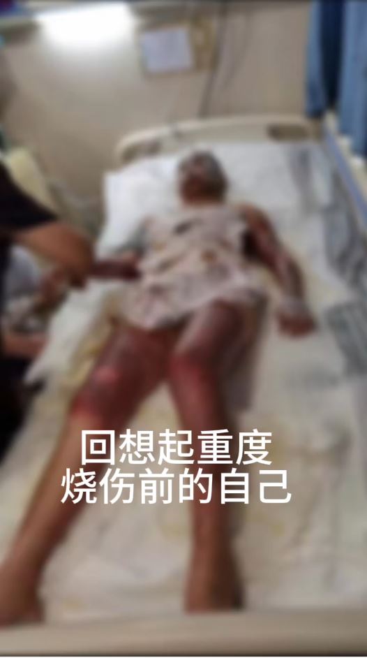 湖北女手機放枕邊通宵叉電，因充電器爆炸燒傷7成皮膚毀容。抖音＠依依的抗疤分享