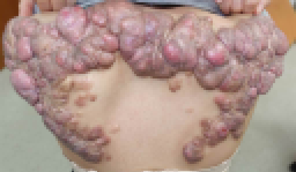 少女背部长出罕见巨大的「蟹足肿」。网上图片