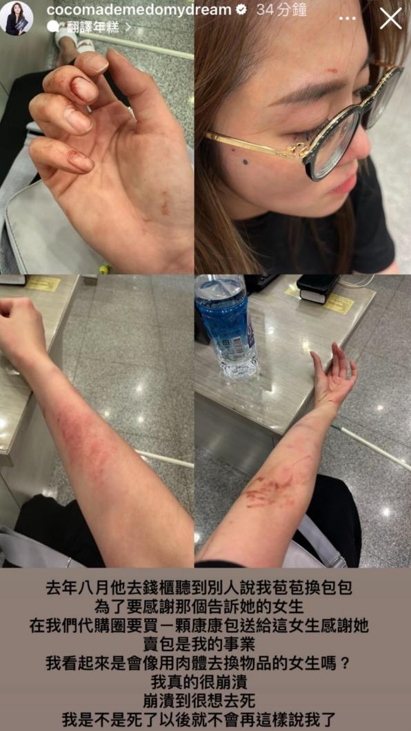 林千又昨日（16日）晒出自己被打傷的照片。