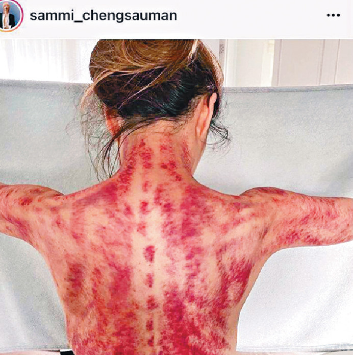 ■Sammi于IG展露刮痧「战绩」。
