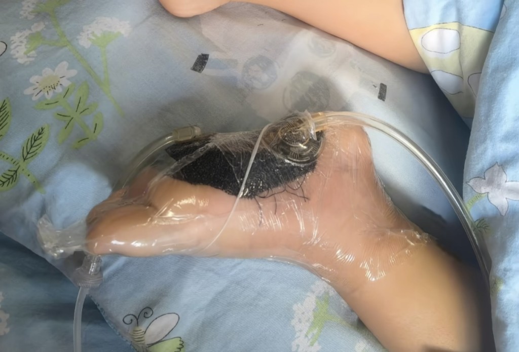 6歲男童沙灘赤腳踩到死魚被扎傷,高燒昏迷險截肢。抖音@路過的風景 6歲男童沙灘赤腳踩到死魚被扎傷,高燒昏迷險截肢。抖音@路過的風景