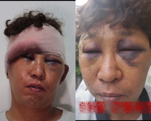 超市巧遇鄰居禮貌打招呼,遭對方男友打致留院12週。影片截圖