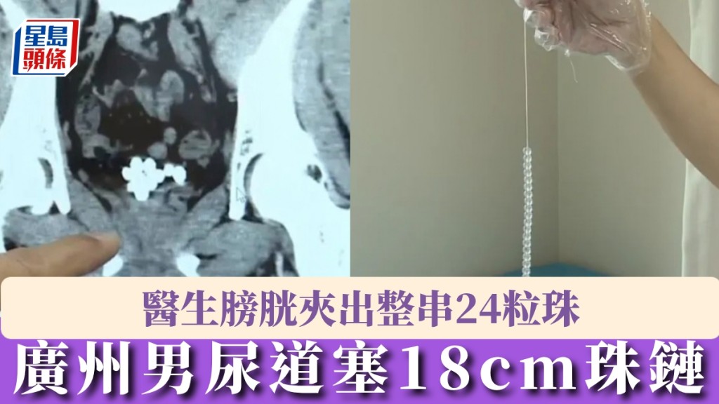 廣州男尿道塞18cm珠鏈，醫生膀胱夾出24粒珠。