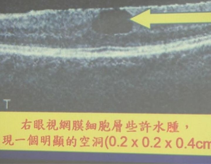 手機藍光結合紫外線後,造成視網膜病變,導致黃女的視網膜出現大洞。網圖