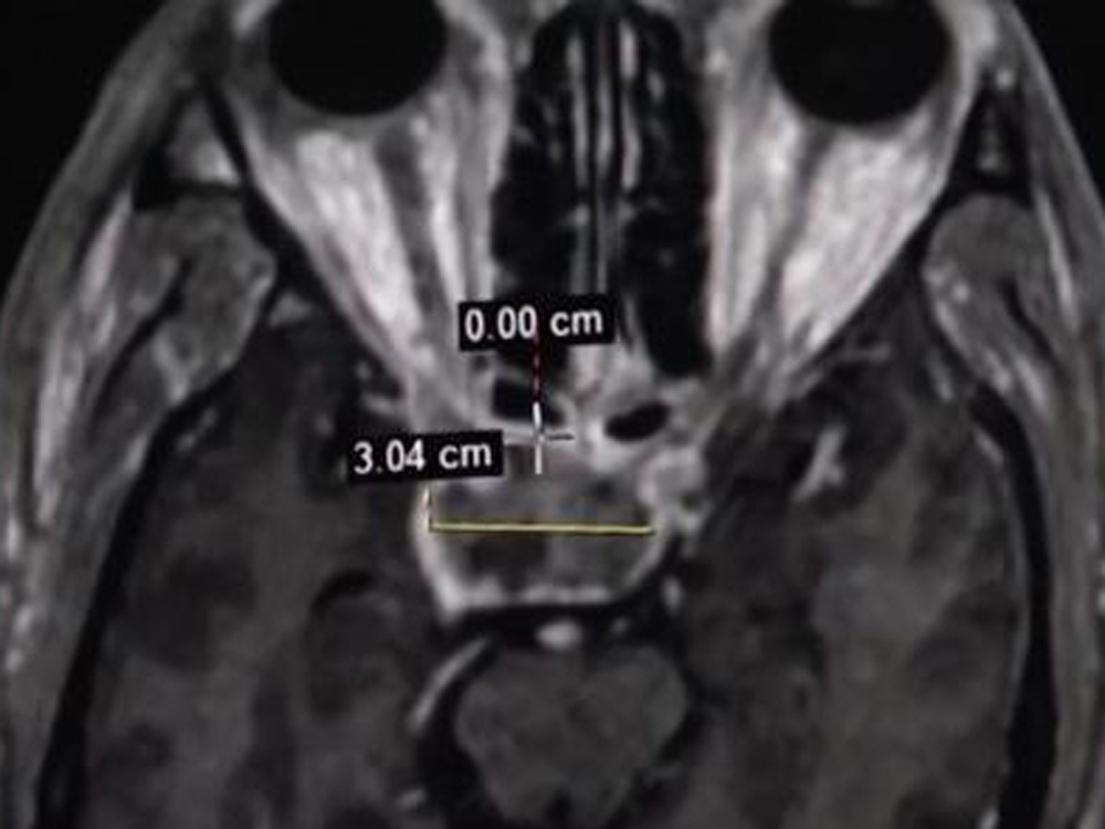 醫師發現病人顱內長了腫瘤。(網圖)