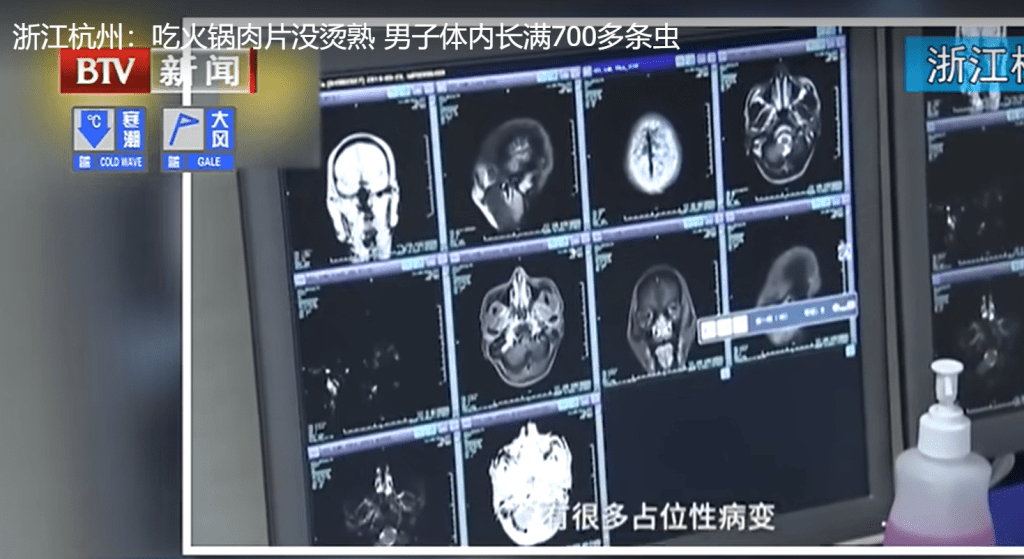 該男子身體多處感染寄生蟲(影片截圖)