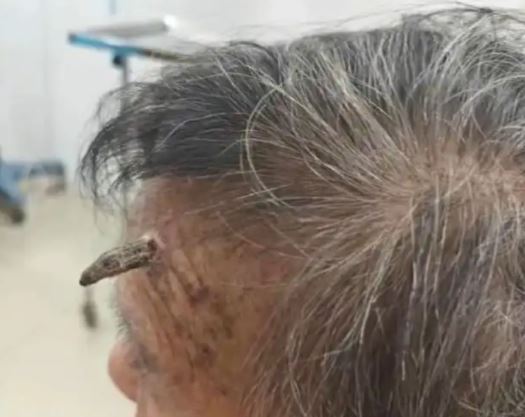 顧婆婆自行剪去額上犄角，險致大出血。環球網