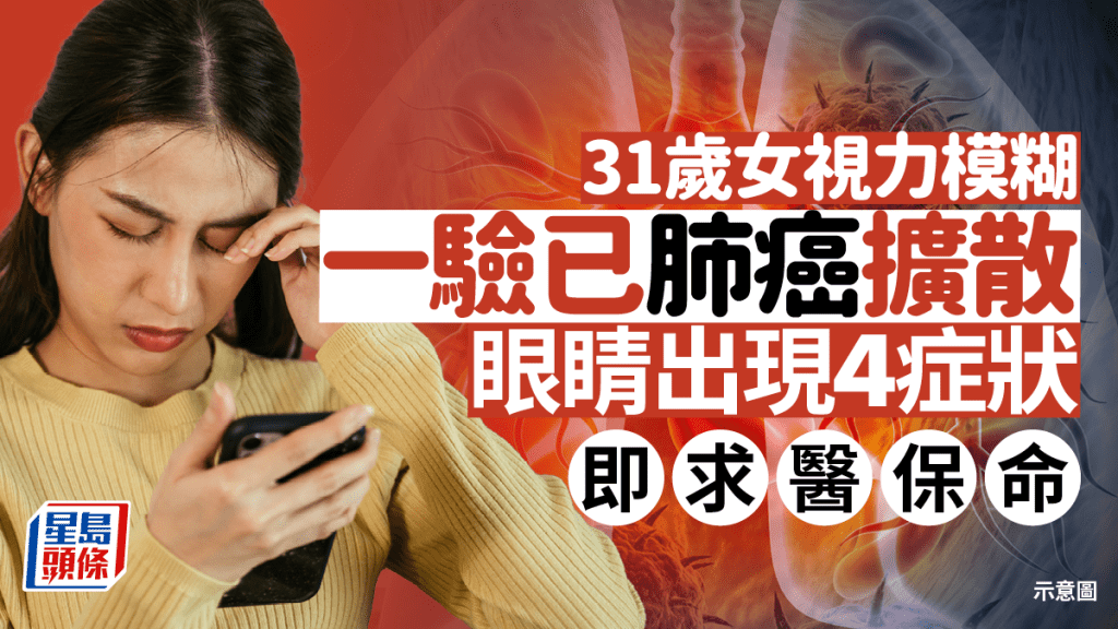 31歲女視力模糊 一驗已肺癌擴散！醫生籲眼睛出現4症狀 即求醫保命