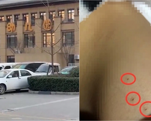 內地一名3歲女童放學後被母親發現身上有疑似針孔。網圖