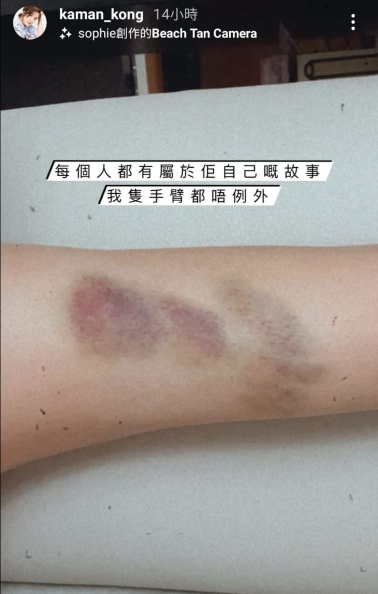 江嘉敏自言瘀痕有一個故事。